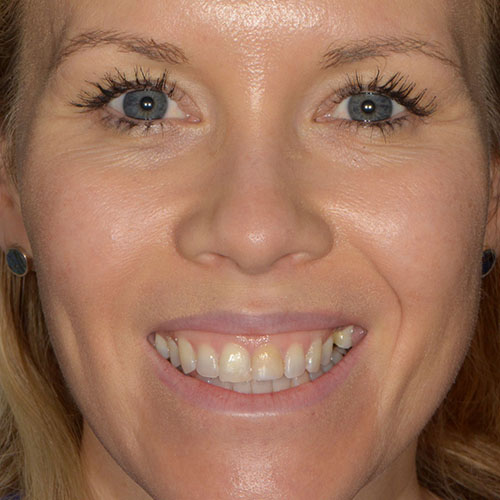 Smile Makeover - Sarah - Before